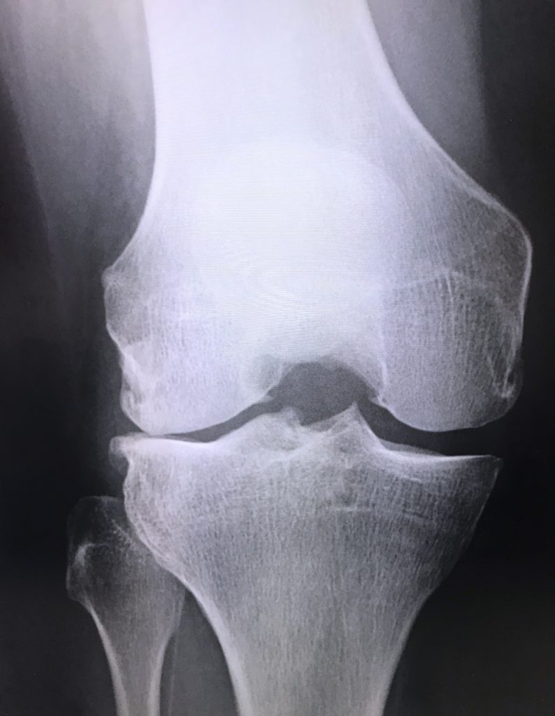 膝関節 痛み サプ